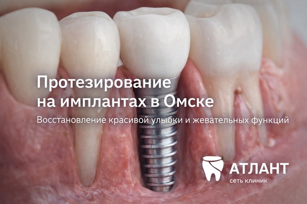 Протезирование зубов и имплантационные технологии: возможности, преимущества и особенности протезирования на имплантах в Омске