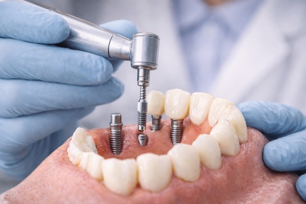 Базальная имплантация и имплантация зубов в современной стоматологии: что это такое, кому подходит и что важно знать перед лечением