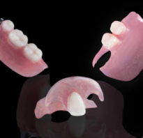 Протезирование зубов при частичном отсутствии зубов