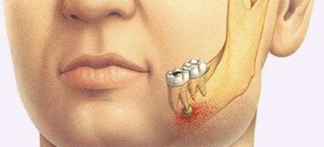Лечение хронического периодонтита в стадии обострения