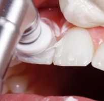 Профессиональная чистка зубов польза или вред