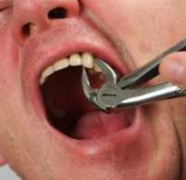 Удаление зуба в домашних условиях