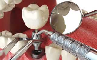 Противопоказания к установке зубных имплантов