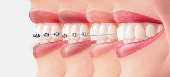 Какие брекеты лучше керамические или металлические