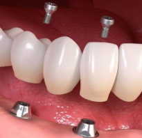 Виды имплантов для зубов от разных производителей