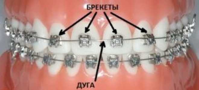 На сколько зубов ставят брекеты