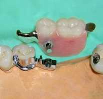 Временный зубной протез на один зуб