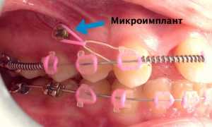 Миниимпланты в ортодонтии