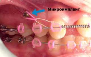Миниимпланты в ортодонтии