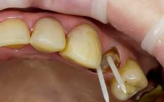 Стекловолокно в стоматологии