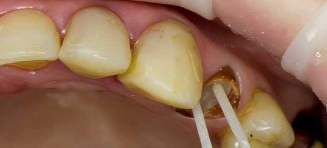 Стекловолокно в стоматологии