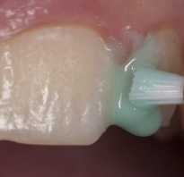 Как очистить зубы от кариеса