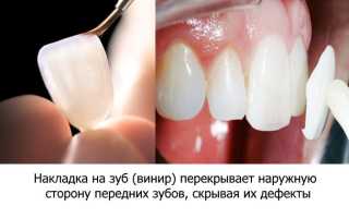 Насадки на зубы виниры
