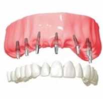 Имплантанты зубов противопоказания