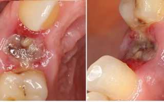 Чистка лунки после удаления зуба