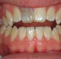 Может ли болеть зуб с удаленным нервом