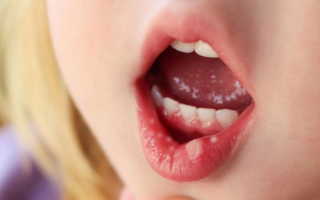 Герпес на губах и во рту лечение