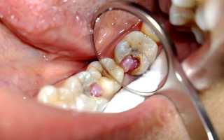 Что помогает при острой зубной боли