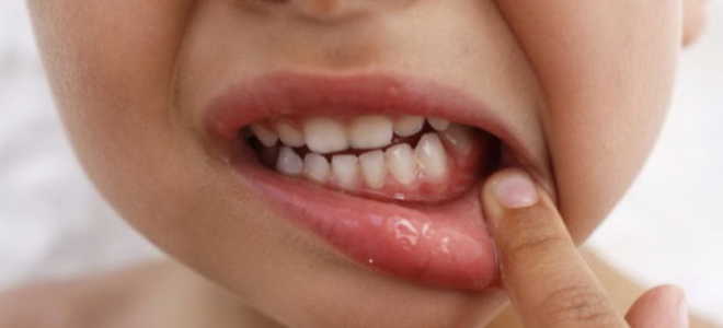 Гингивит у детей симптомы