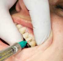 Какая анестезия лучше при лечении зубов