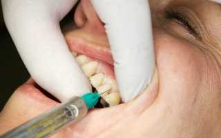 Анестезия в стоматологии побочные эффекты
