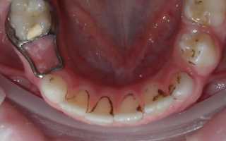 Черные зубы у детей причины комаровский