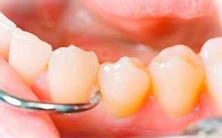Киста зуба операция