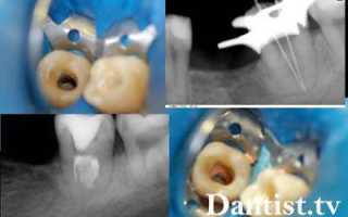 Восстановление зуба от корня