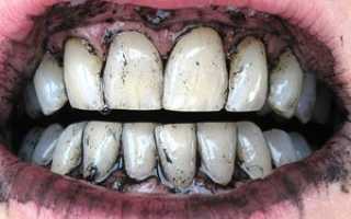 Отбеливание зубов в домашних условиях активированным углем