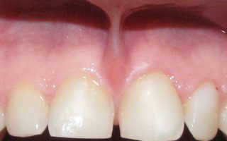 Подрезание уздечки верхней губы у детей