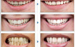 Безопасное отбеливание зубов в стоматологии