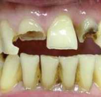 Что такое реставрация зубов