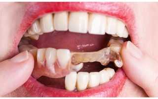 Эластичные зубные протезы
