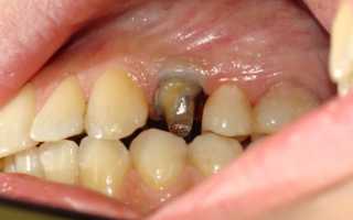 Что такое вкладки в протезируемые зубы