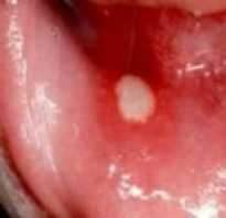 На слизистой рта белое пятно болит