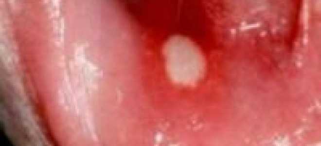 Как называется болячка во рту белая