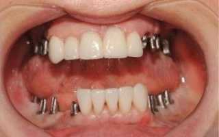 Временные протезы на зубы