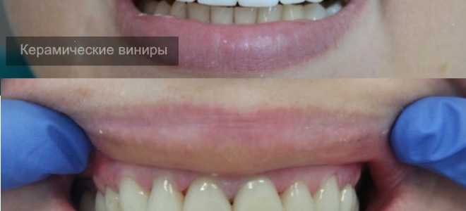 Виниры керамические или композитные