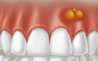 Гнойное воспаление десны возле зуба лечение