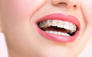 Почему зубы болят после установки брекетов