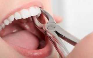 Как чистить зубы после удаления