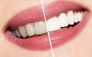 Белые пятна на зубах после отбеливания