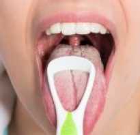 Чем лечить кандидоз во рту