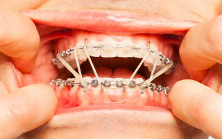 Почему не болят зубы после установки брекетов