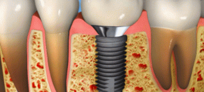 Где можно поставить импланты качественно и недорого
