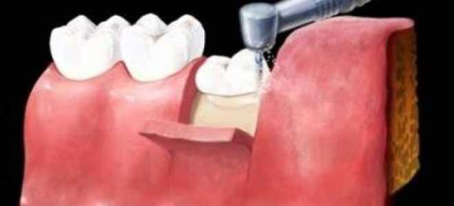 После удаления зуба мудрости болит лимфоузел