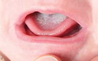 Кандидоз полости рта у ребенка