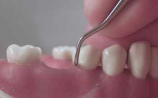 Что такое шинирование зубов