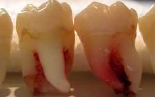 Больно ли вырывать коренной зуб