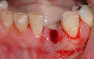 Болит лунка после удаления зуба